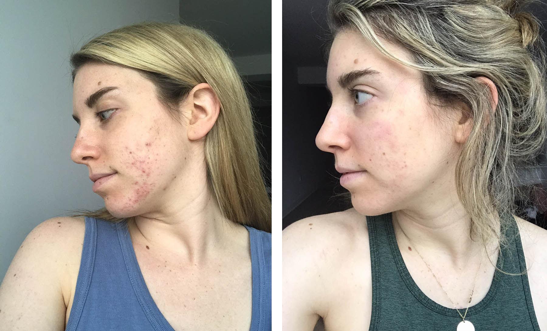 hormonal acne